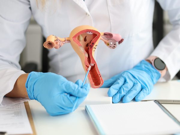 Kyste Ovarien :  Témoignage​s de femmes, et Symptômes​